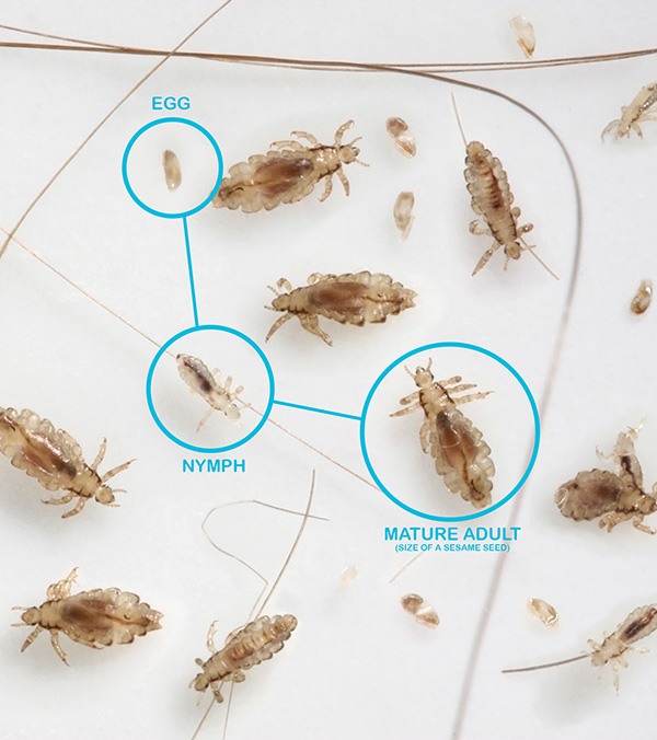 Head Lice Pictures | Nits, Nymphs, Louse and Head Lice Eggs | NitWits